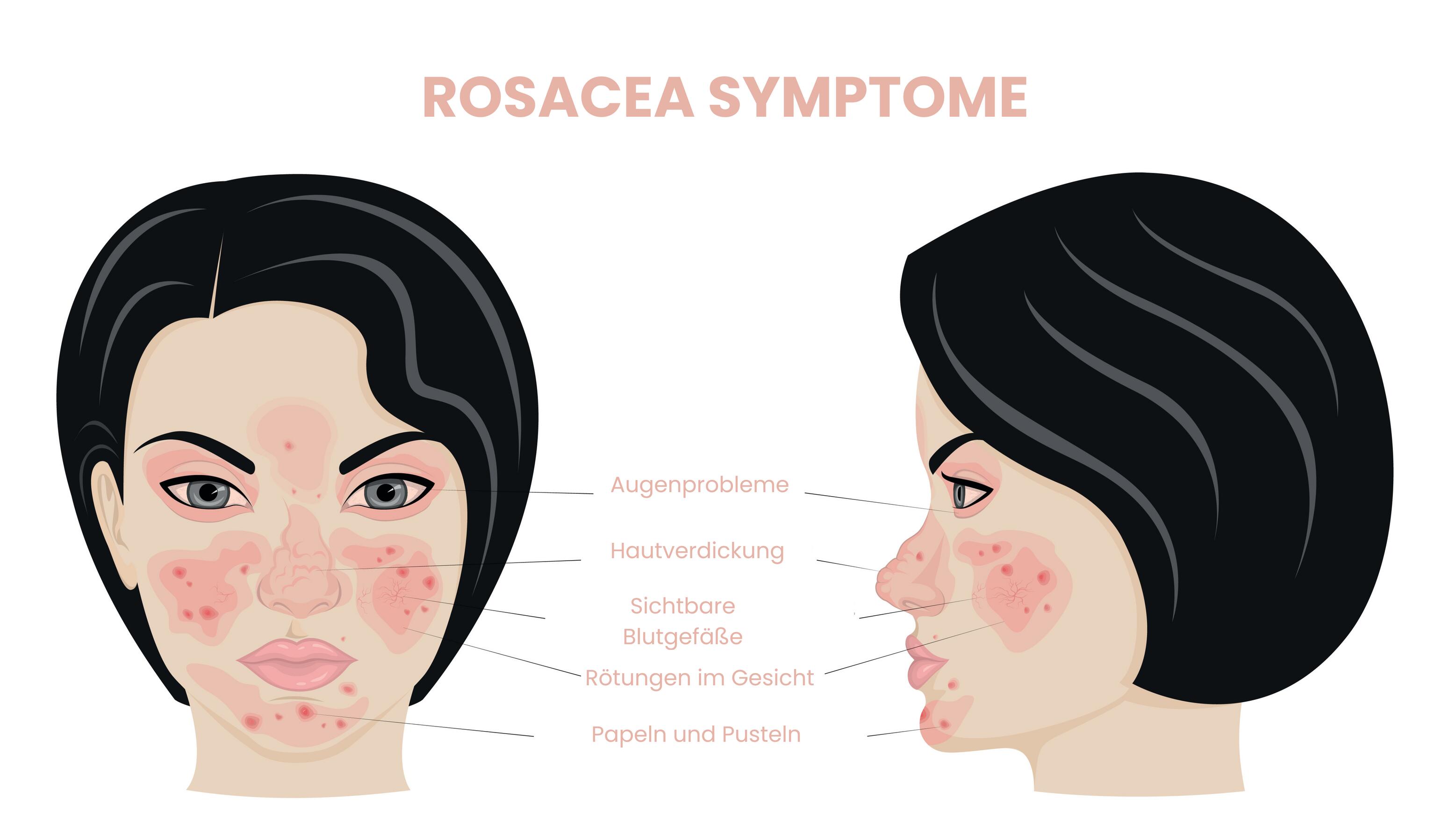 Eine Infografik zeigt die Symptome von Rosacea wie Rötungen, sichtbare Blutgefäße, Augenprobleme und Pusteln.